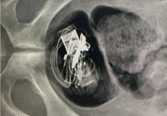 Homem forÃ§a a prÃ³pria prisÃ£o para levar droga, fone de ouvido e pen drive para dentro de cadeia no PR