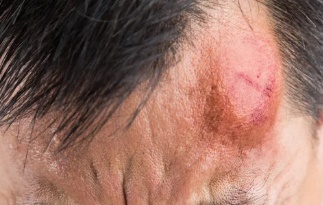 LS: Pai é agredido por filho adolescente com paulada na cabeça